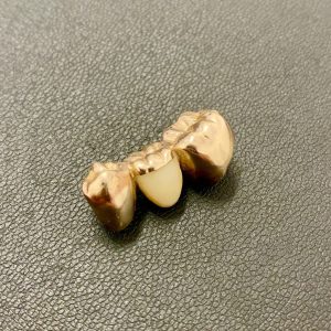 金歯