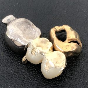 金歯 / 銀歯混合