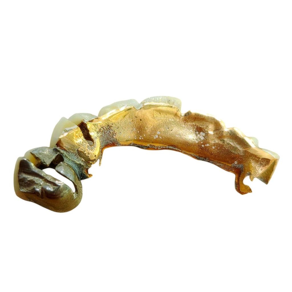 金歯