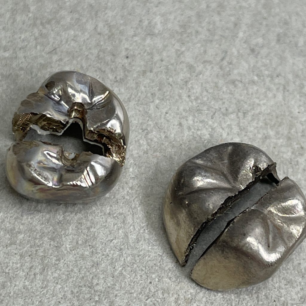 銀歯、金歯、入れ歯も買取強化中！| 銀歯の買取 | 取手市井野団地