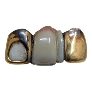 金歯(歯がついたまま)