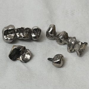 銀歯 除去冠 クラウン インレー