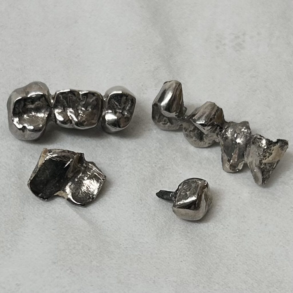 銀歯 除去冠 クラウン インレー